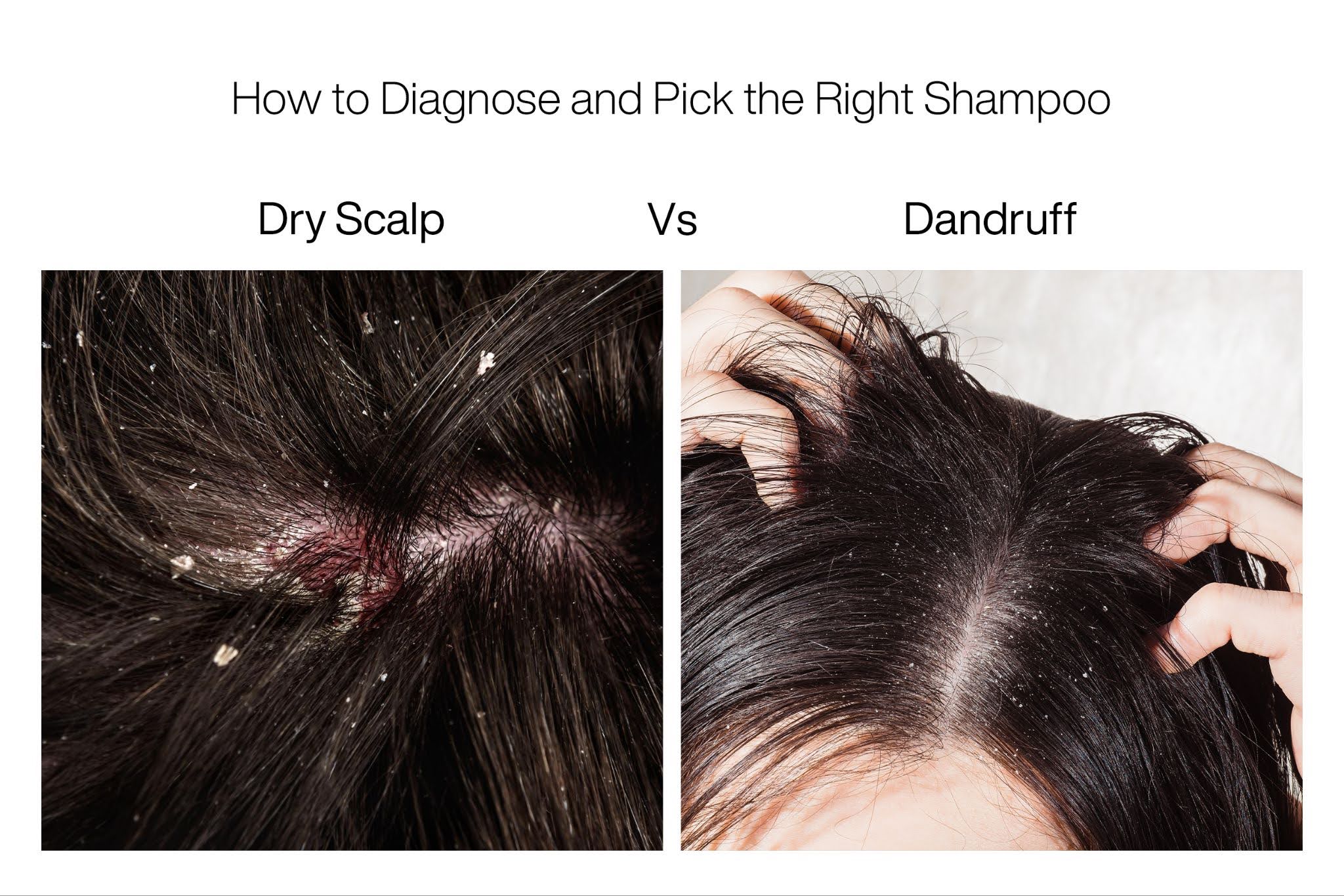 Comparison of dry scalp (left) and dandruff (right) showing different flaking and scalp conditions for diagnosis and shampoo selection.